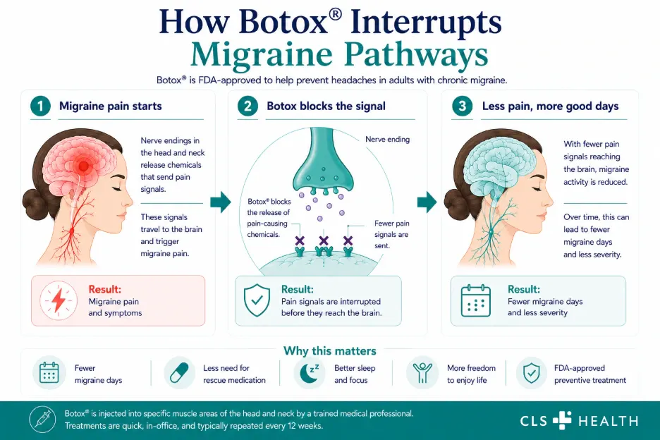 An infographic showing how botox interrupts migraine pathways.