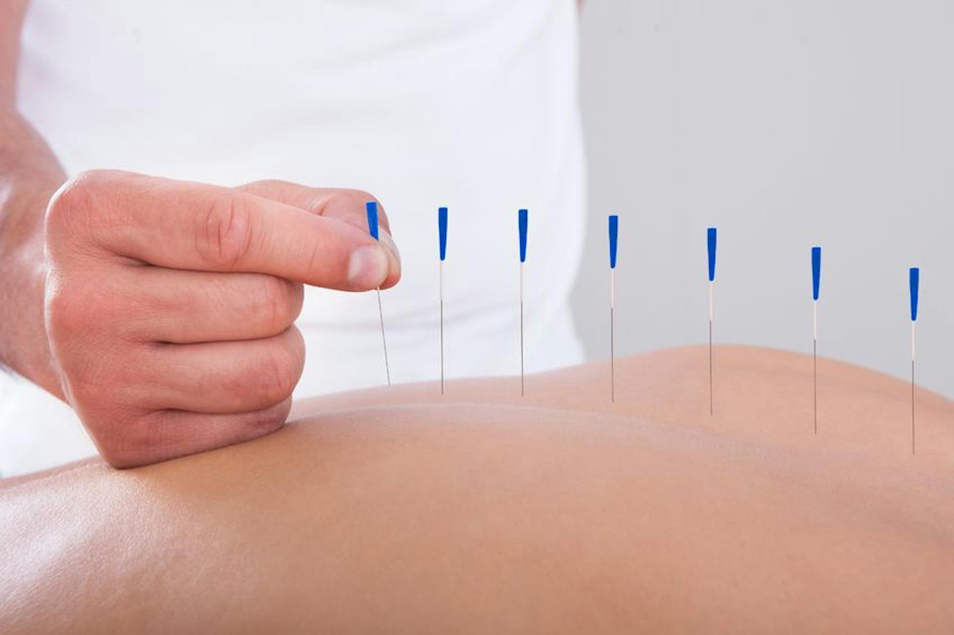 Acupuncture 3
