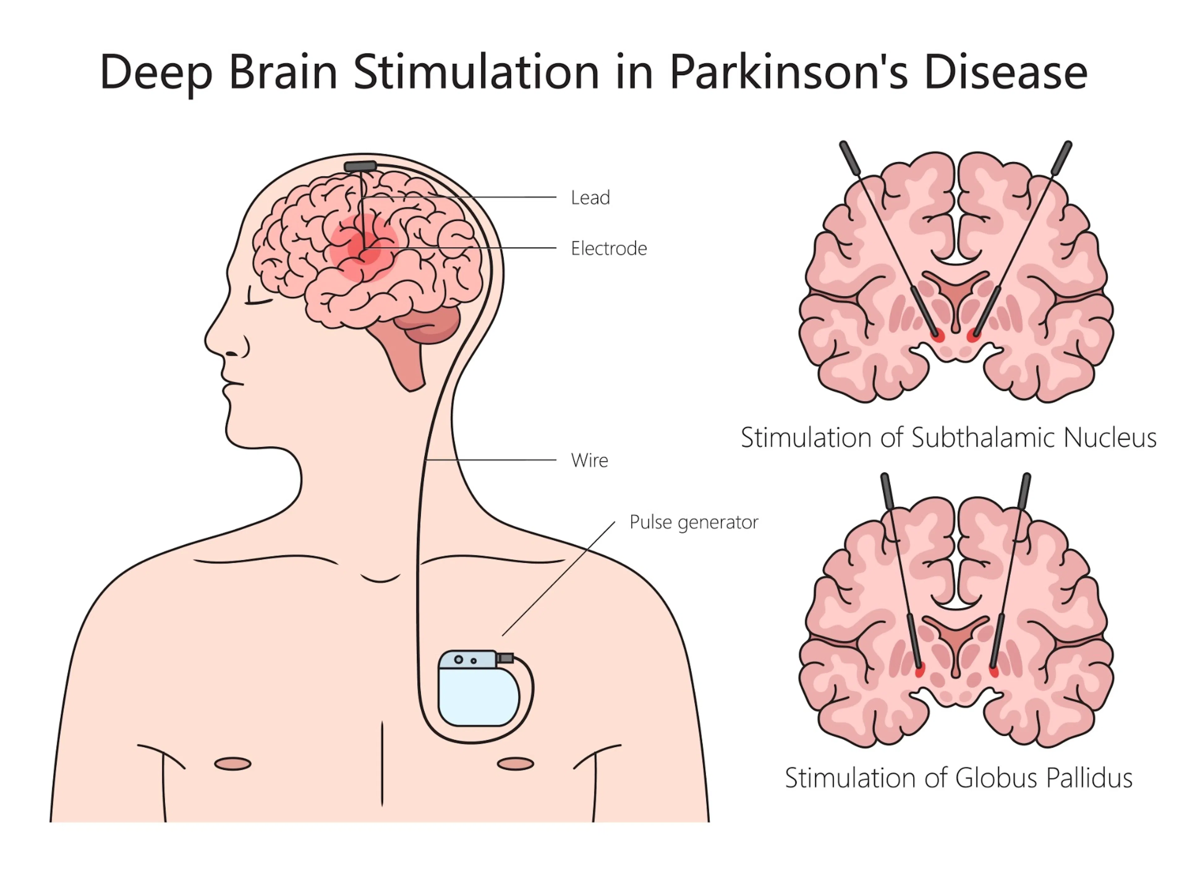 Diagram of deep brain stimulation for Parkinson’s disease
