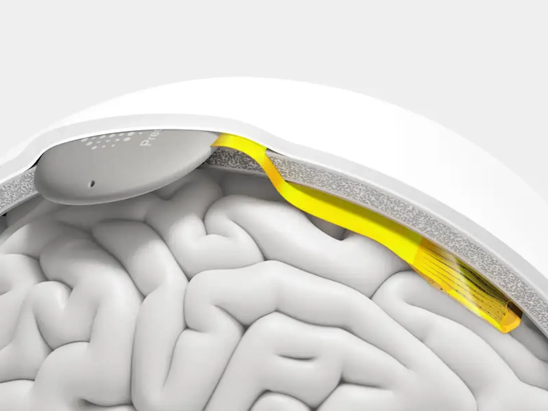 Medical illustration of a brain with implanted electrode
