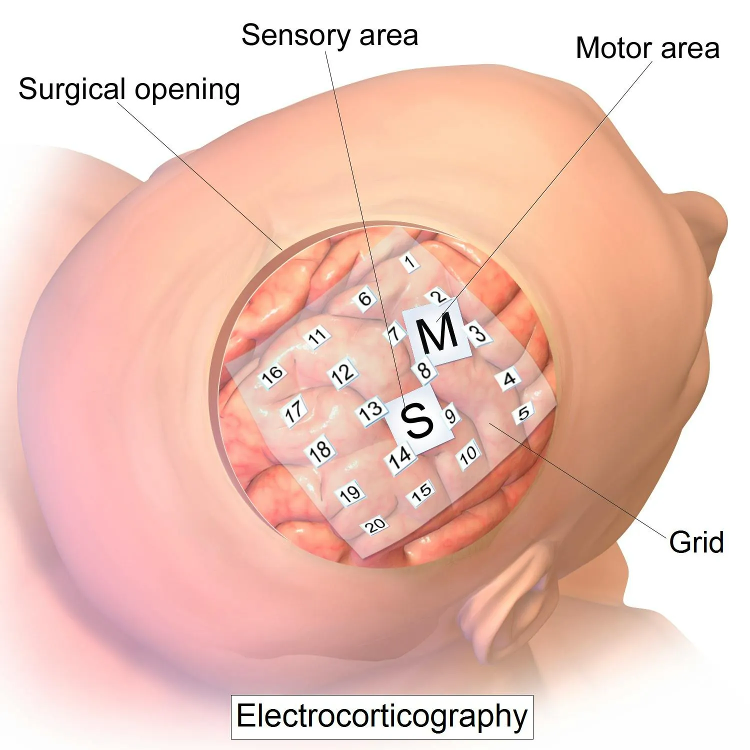 Illustration of electrocorticography, a numbered electrode grid laid directly on the cortex through a surgical opening