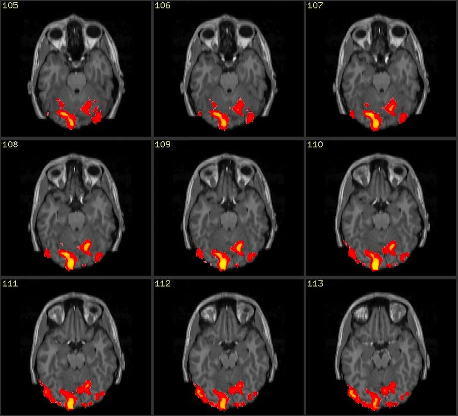 Grid of nine fMRI brain slices with activated regions highlighted in red and yellow
