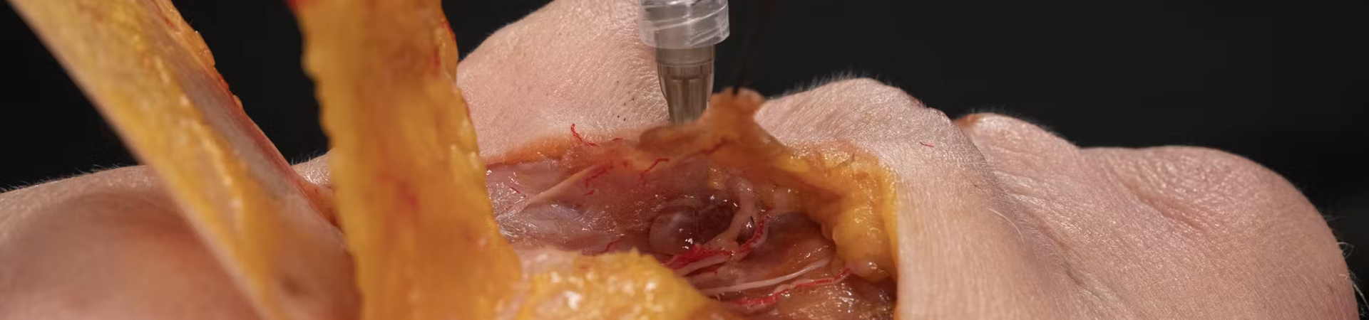Nasolabial fold Treatments: Pyriform fossa with Needle