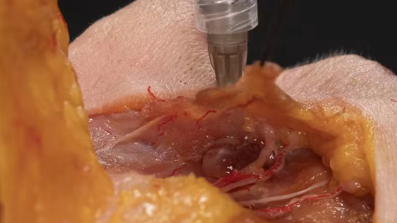 Nasolabial fold Treatments: Pyriform fossa with Needle
