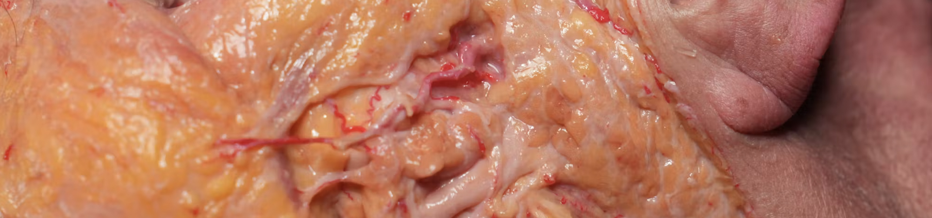 Basic Anatomy for Neuromodulator Treatments: Masseter Muscle