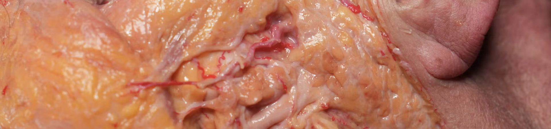 Basic Anatomy for Neuromodulator Treatments: Masseter Muscle