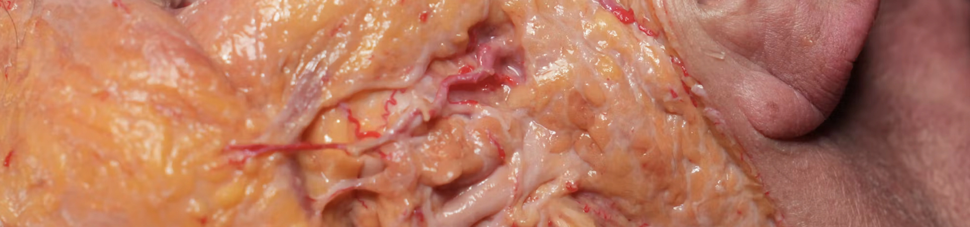 Basic Anatomy for Neuromodulator Treatments: Masseter Muscle