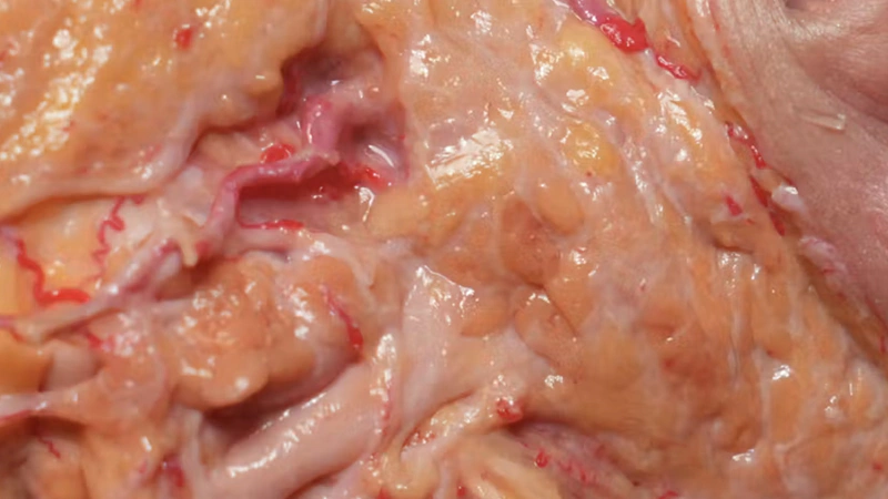 Basic Anatomy for Neuromodulator Treatments: Masseter Muscle