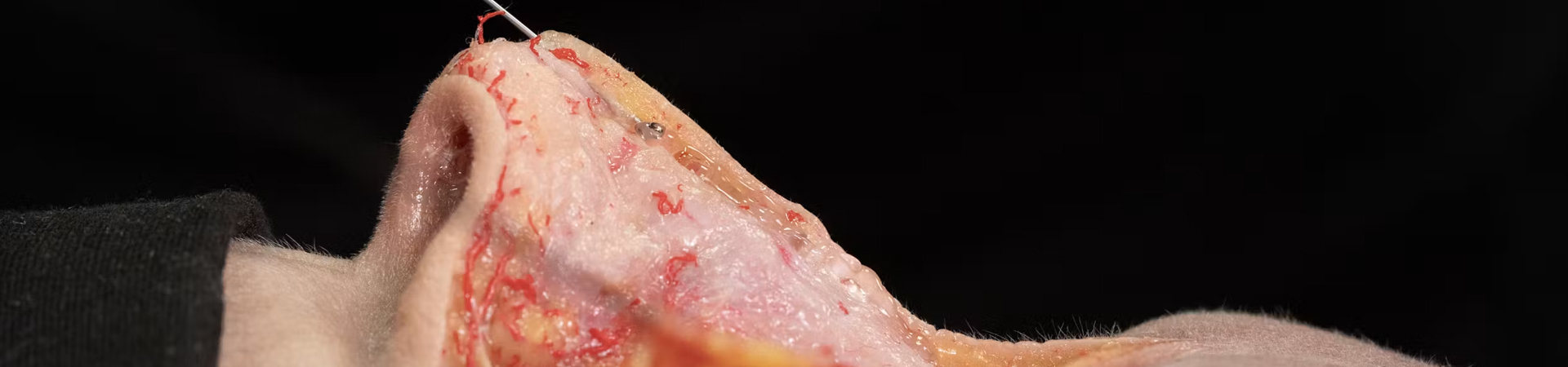 Nose Treatments: Dorsal Enhancement with Cannula