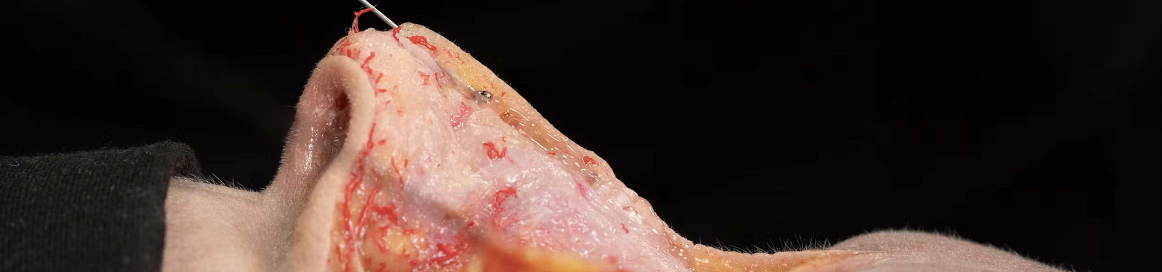 Nose Treatments: Dorsal Enhancement with Cannula