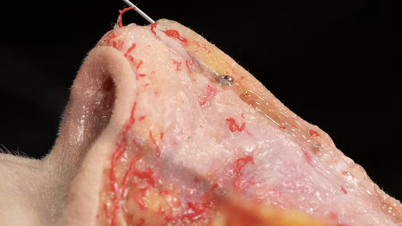 Nose Treatments: Dorsal Enhancement with Cannula