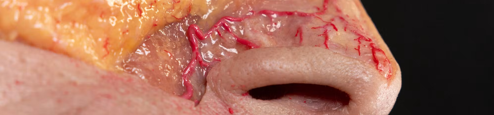 Nasolabial fold Treatments: Intradermal Needle Technique