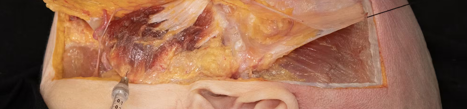 Mandibular Enhancement with Needle