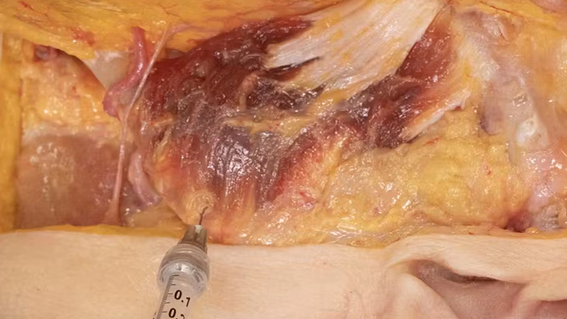 Mandibular Enhancement with Needle
