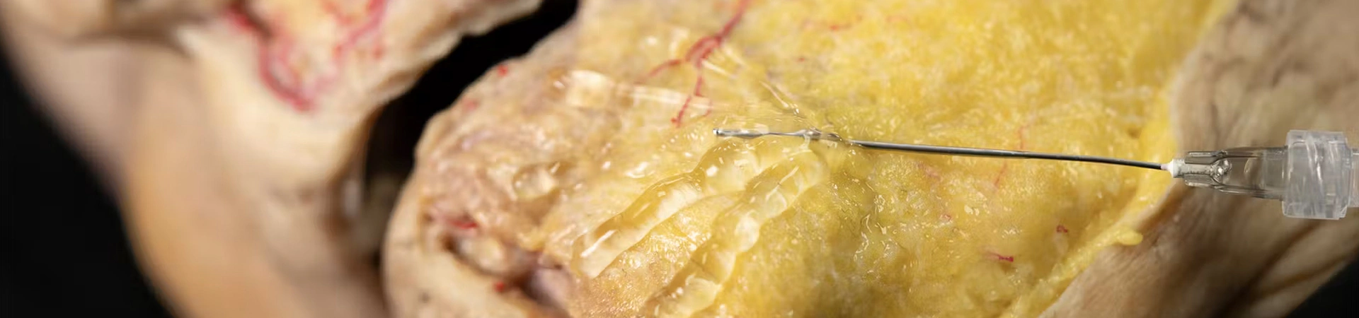 Chin Zone Treatment with Cannula