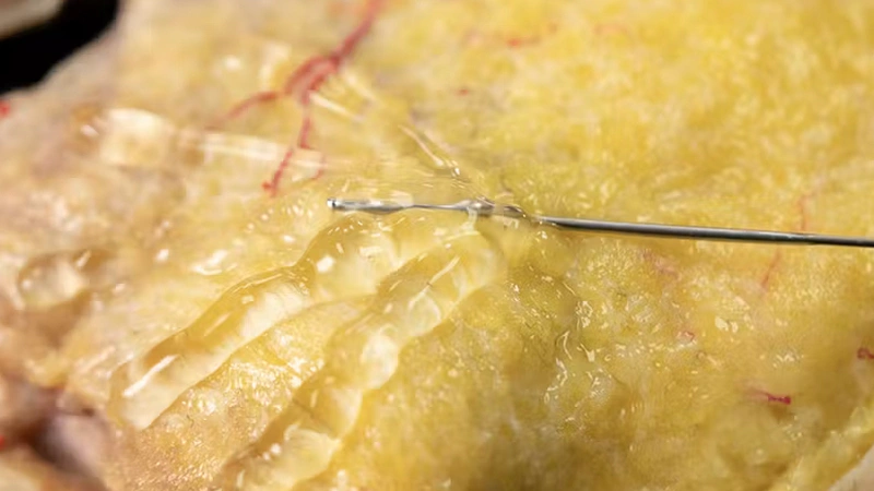 Chin Zone Treatment with Cannula