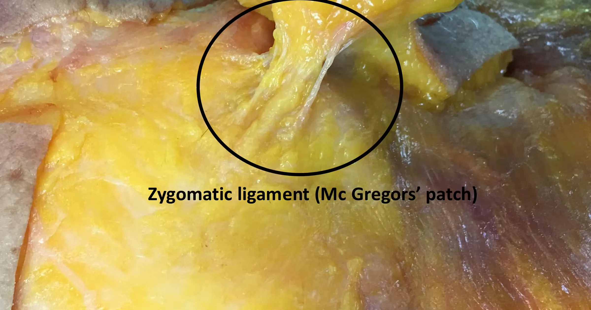 Zygomatic ligament Mc Gregor's patch photograph