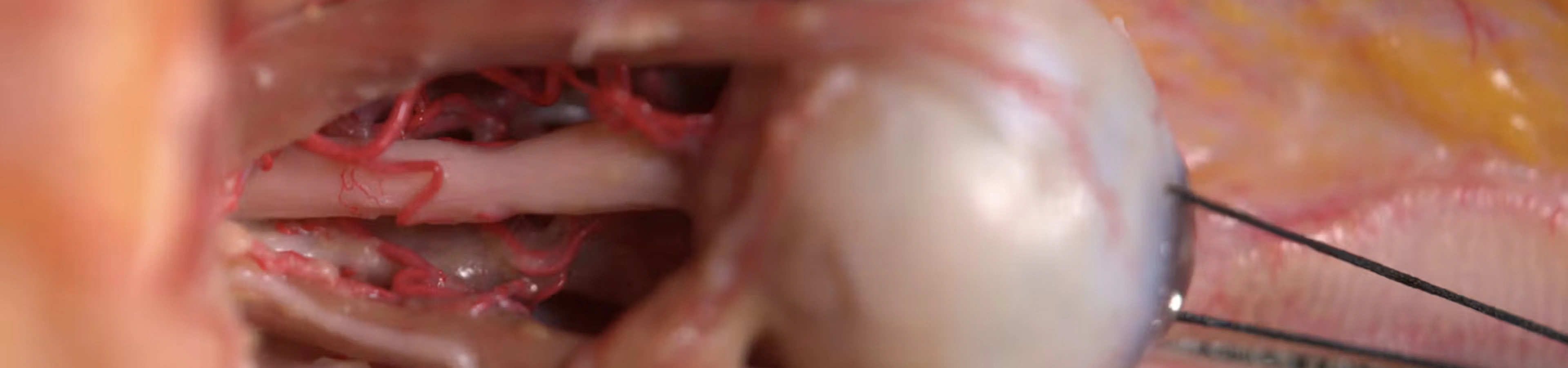 Basic Anatomy and Danger Zones: Periorbital