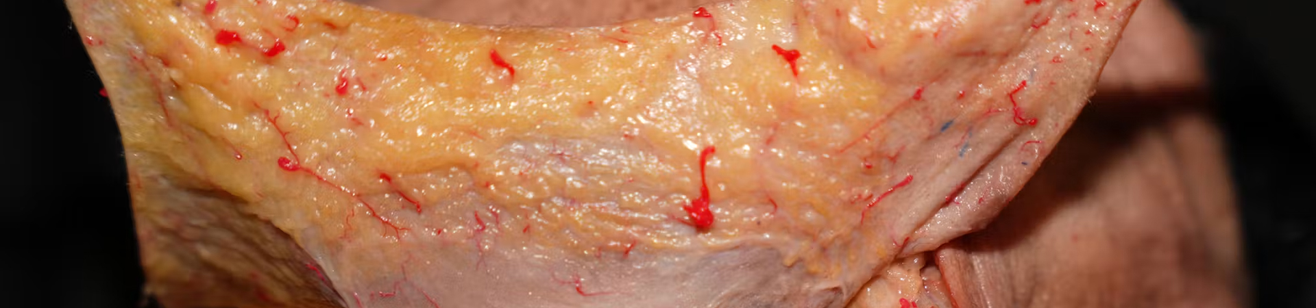 Nasolabial fold Treatments: The Fern Technique