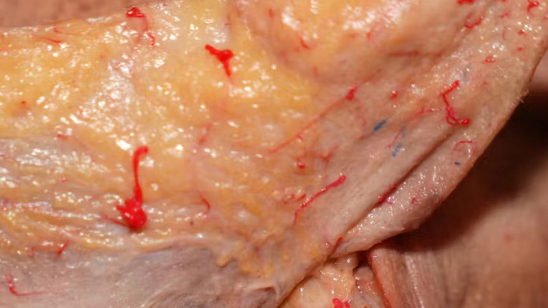 Nasolabial fold Treatments: The Fern Technique