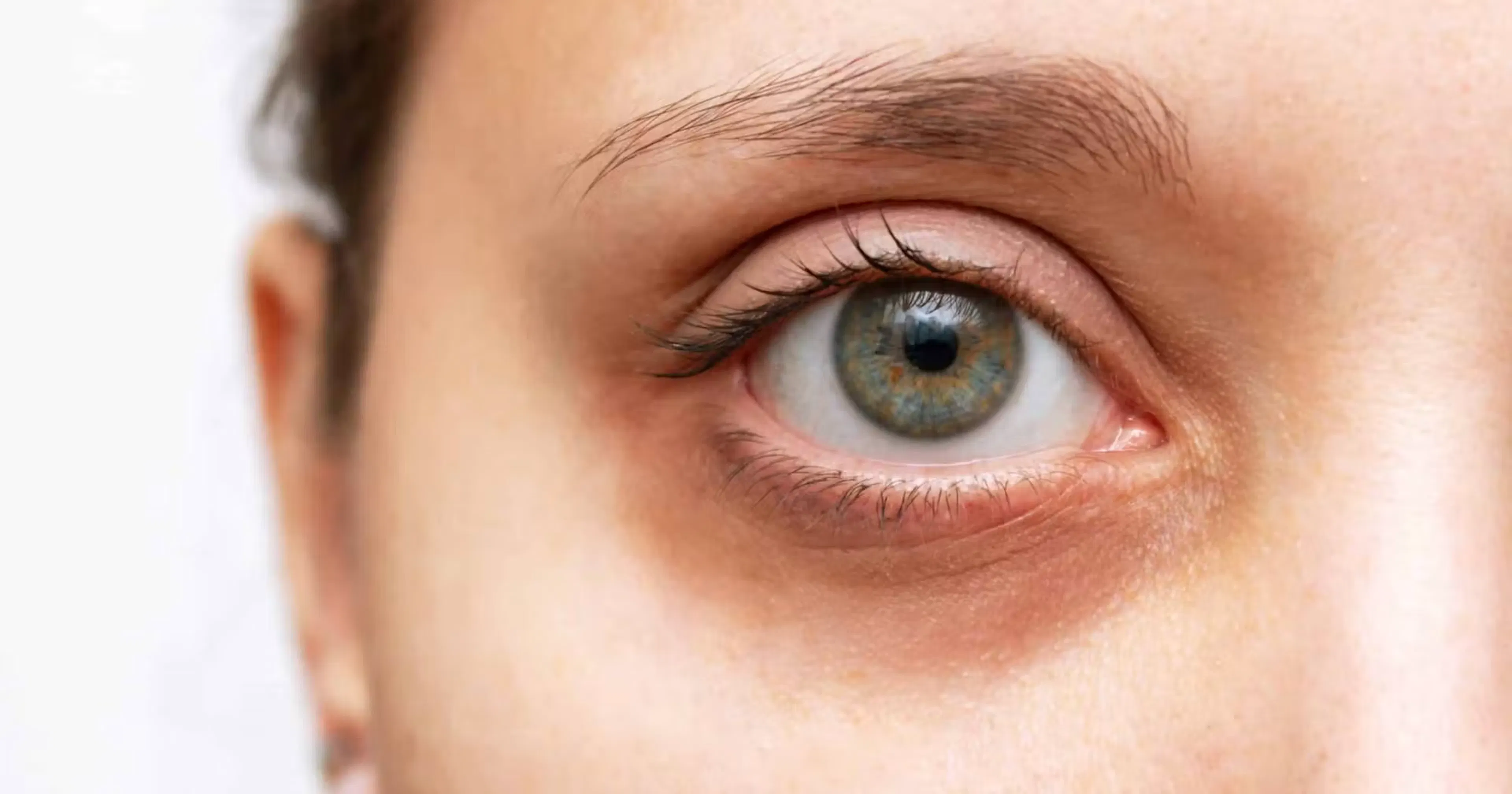 A female with infraorbital hollows