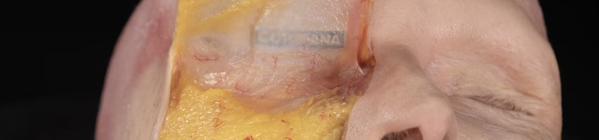 Tear Trough Treatments: Superficial Cannula Technique (Inferior Approach)