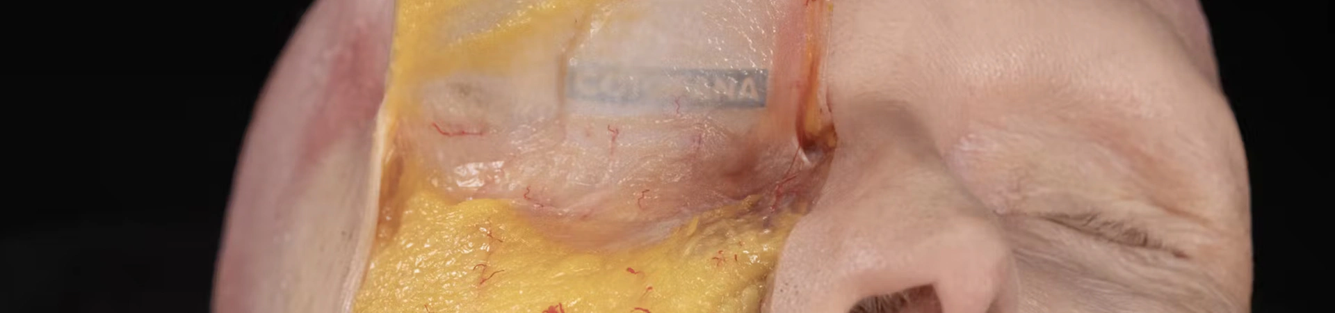 Tear Trough Treatments: Superficial Cannula Technique (Inferior Approach)