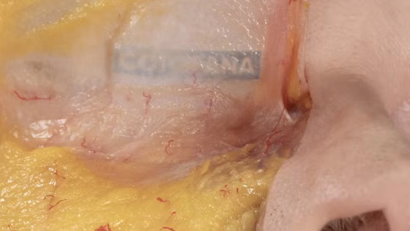 Tear Trough Treatments: Superficial Cannula Technique (Inferior Approach)