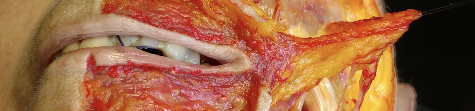 Basic Anatomy for Neuromodulator Treatments: DAO & DLI Muscles