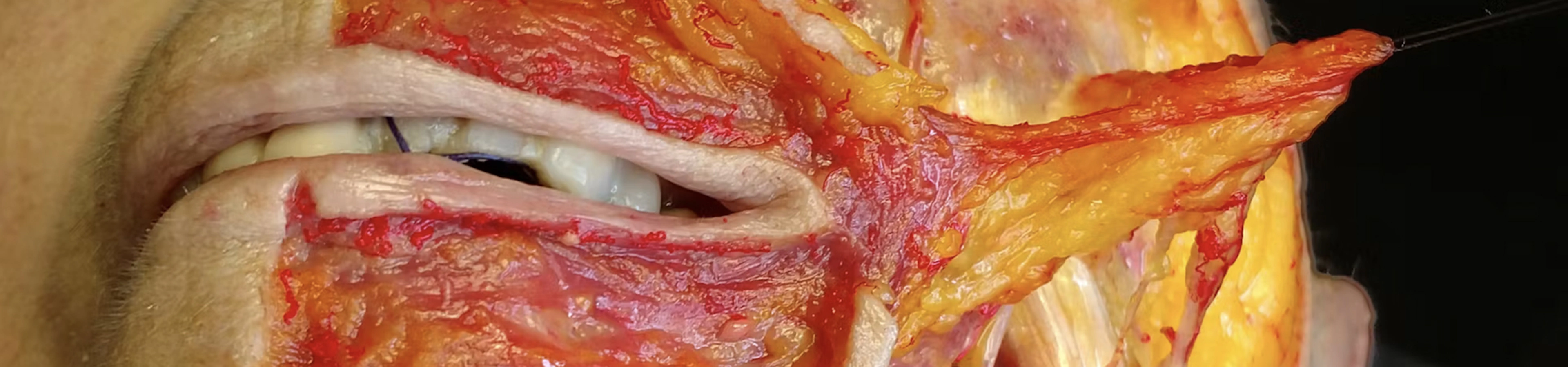 Basic Anatomy for Neuromodulator Treatments: DAO & DLI Muscles