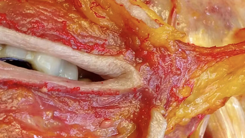 Basic Anatomy for Neuromodulator Treatments: DAO & DLI Muscles
