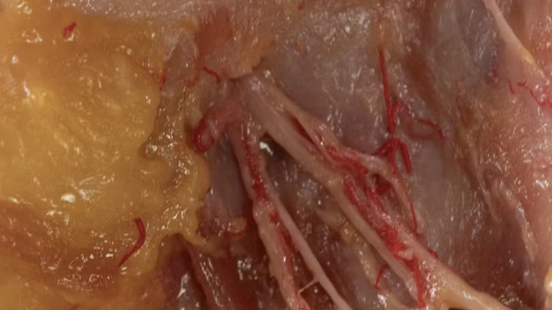 Basic Anatomy and Danger Zones: Medial Midface