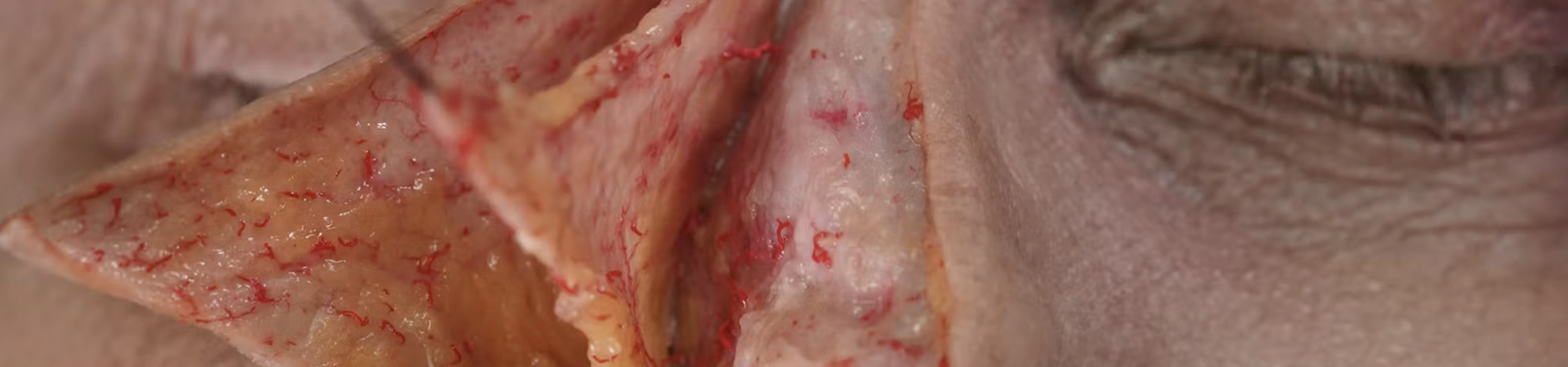 Neuromodulator Treatments: Bunny Lines