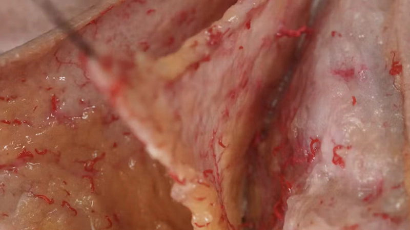 Neuromodulator Treatments: Bunny Lines
