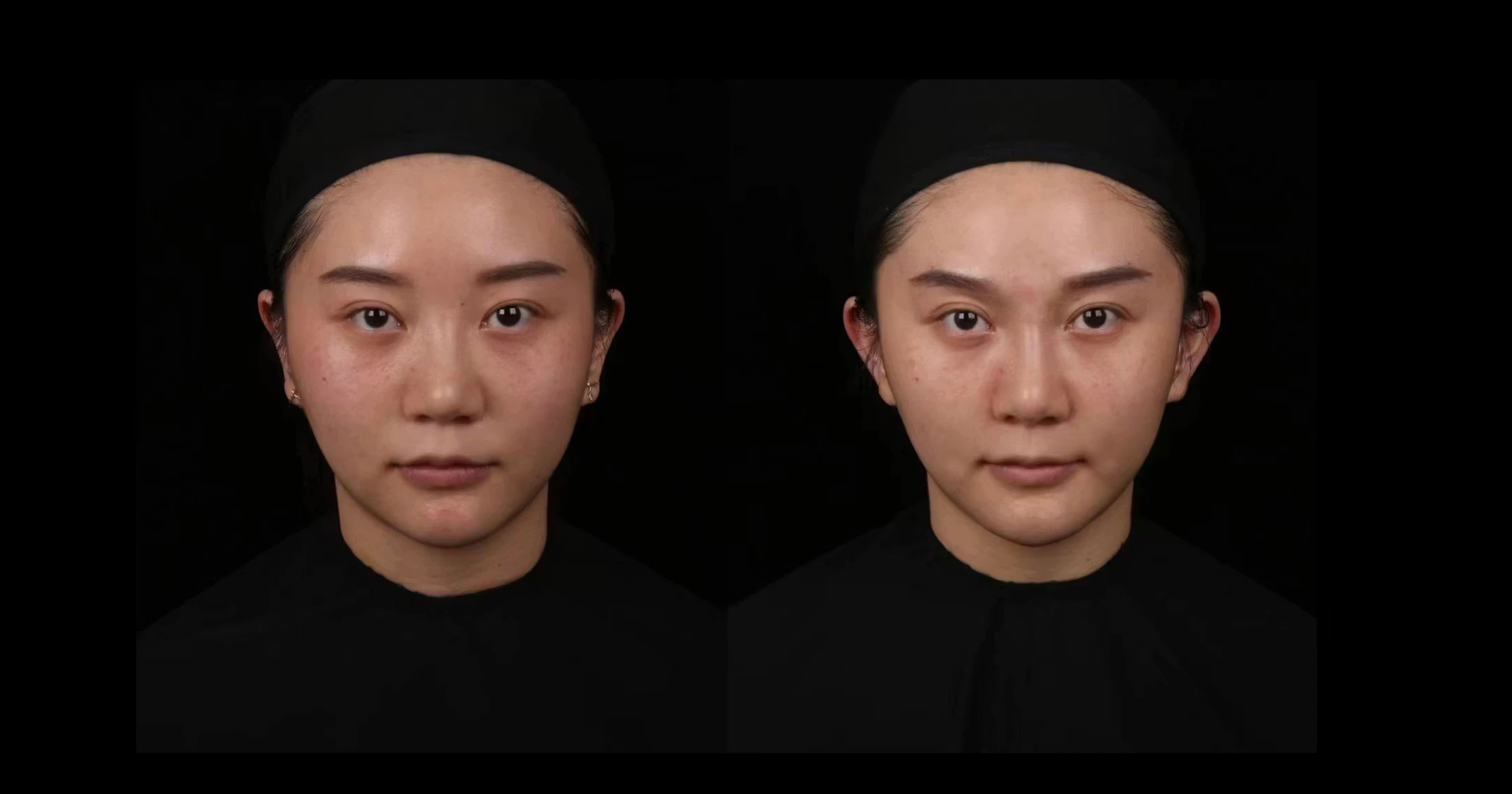 Photographic study of lateralizing the auricles