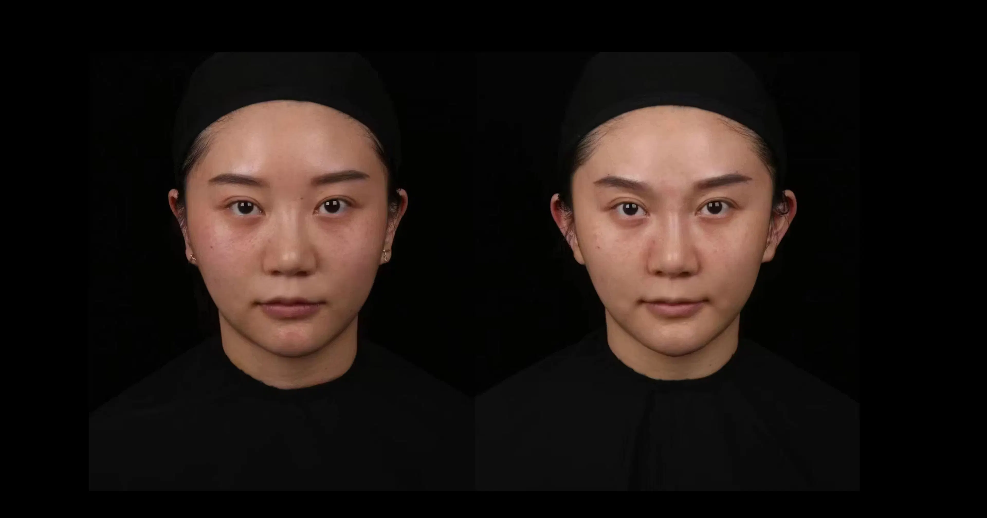 Photographic study of lateralizing the auricles
