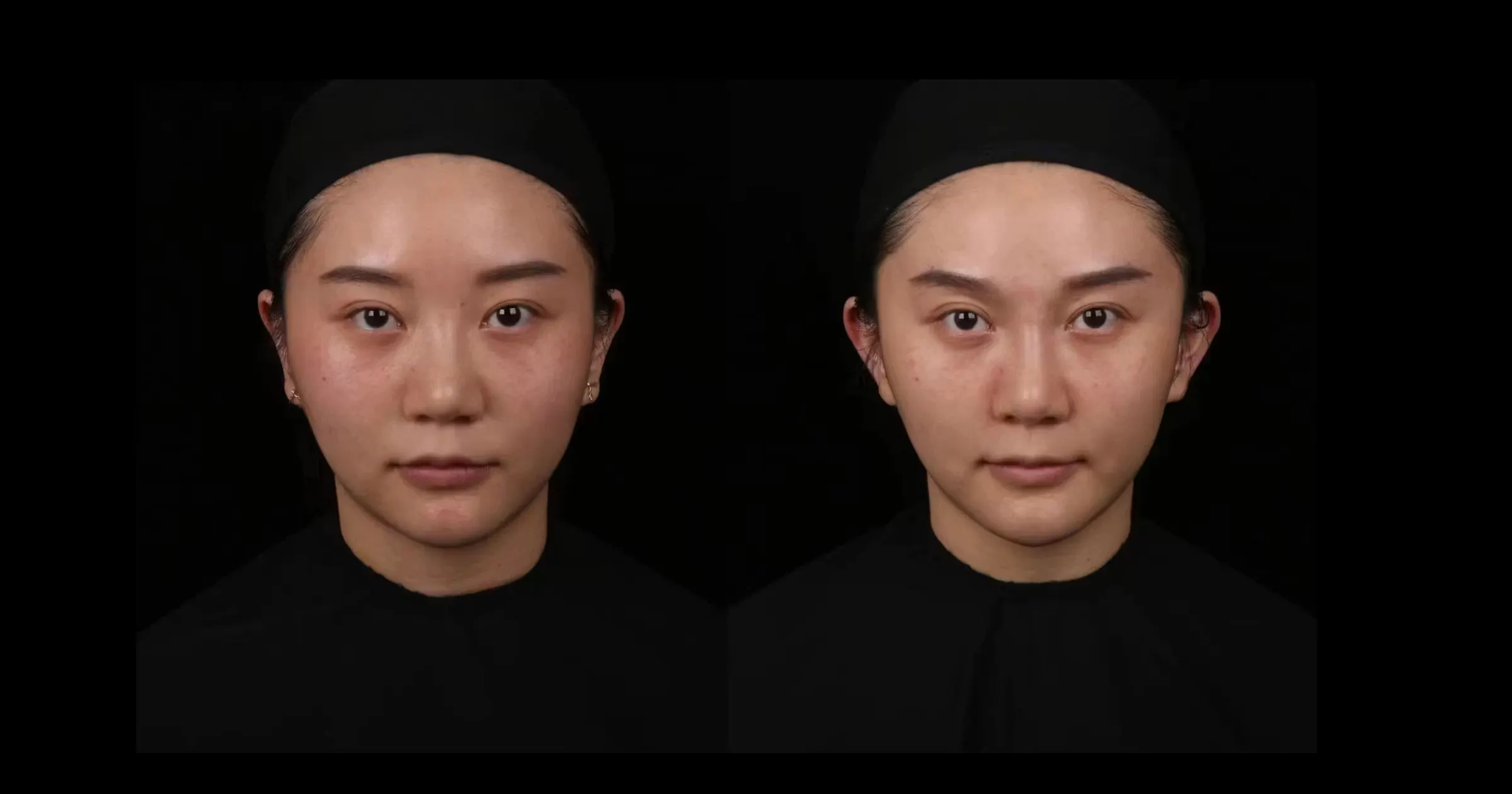 Photographic study of lateralizing the auricles