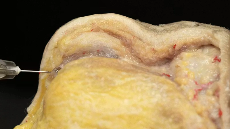 Chin Zone Treatment with Needle