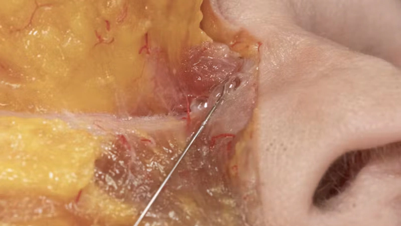 Tear Trough Treatments: Deep Cannula Technique (Inferior Approach)
