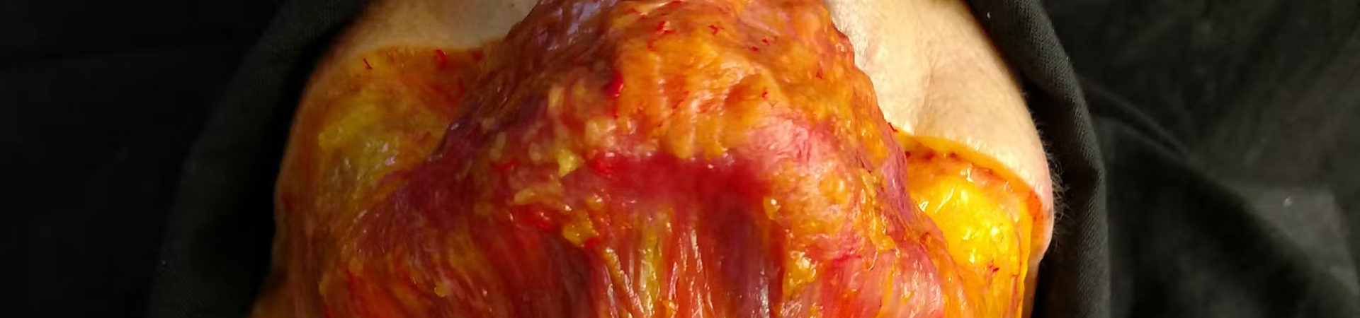 Horizontal Neck Lines Intradermal Needle Technique