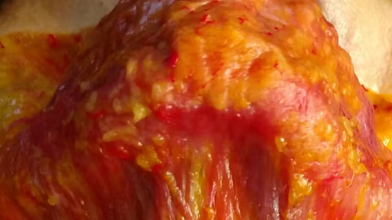 Horizontal Neck Lines Intradermal Needle Technique