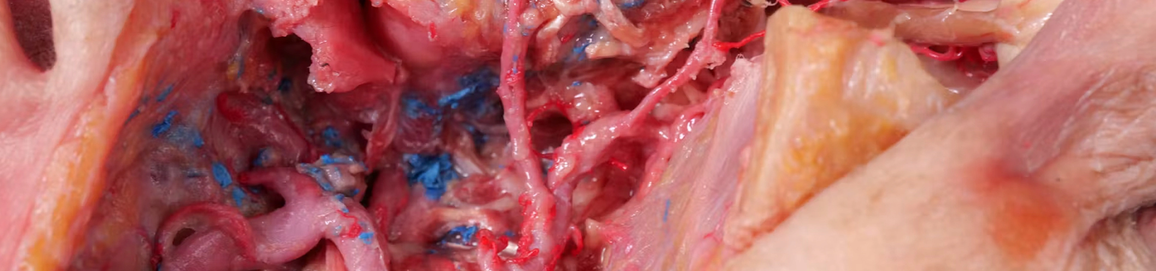 Extended Anatomic Review: The Maxillary Artery