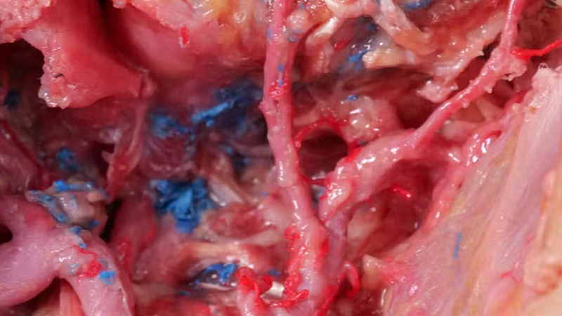 Extended Anatomic Review: The Maxillary Artery