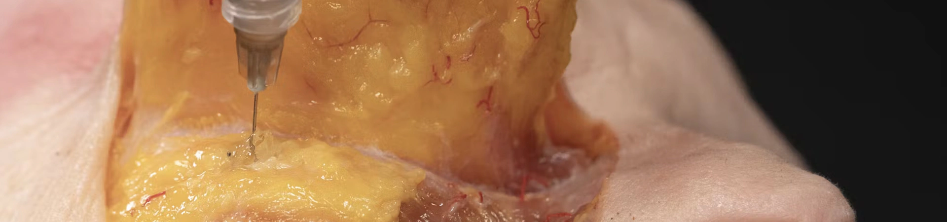 Cheek Volumization with Needle