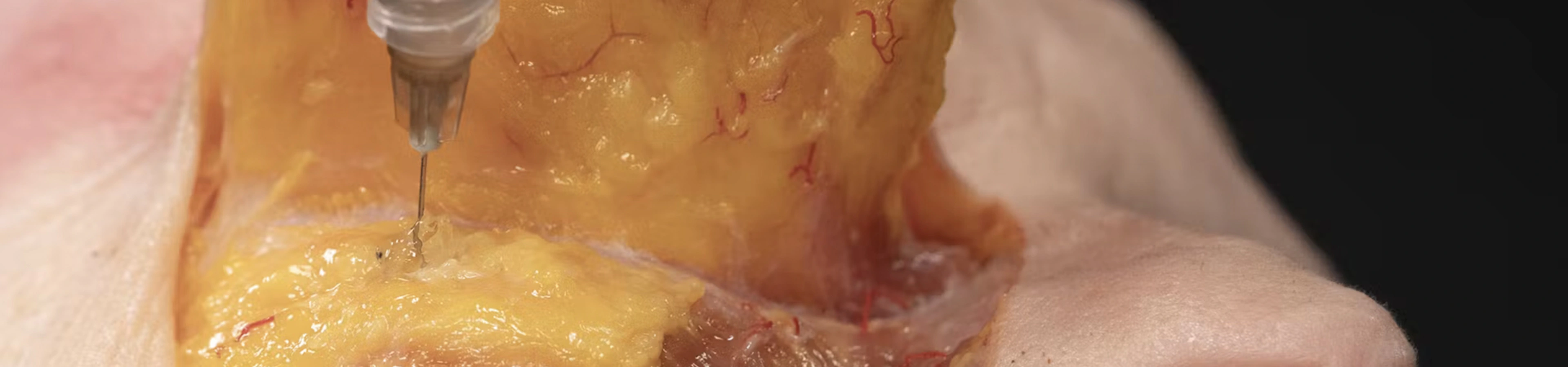 Cheek Volumization with Needle