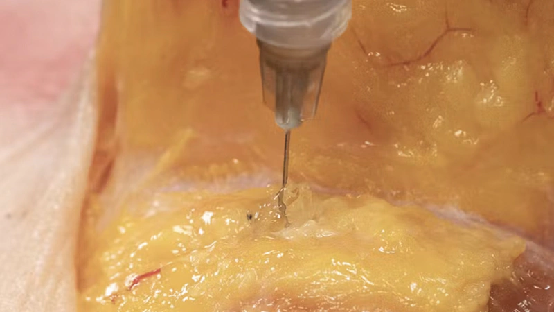 Cheek Volumization with Needle