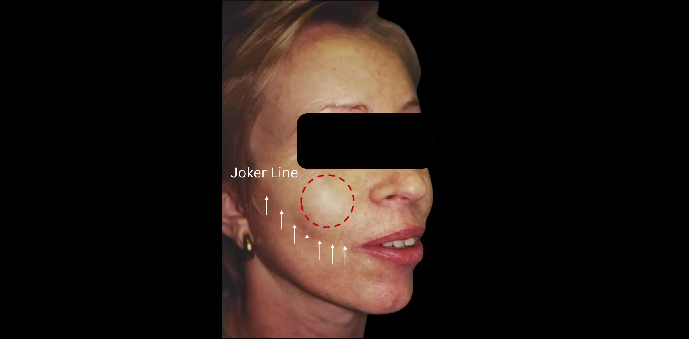 Photographic image of a females facial joker line