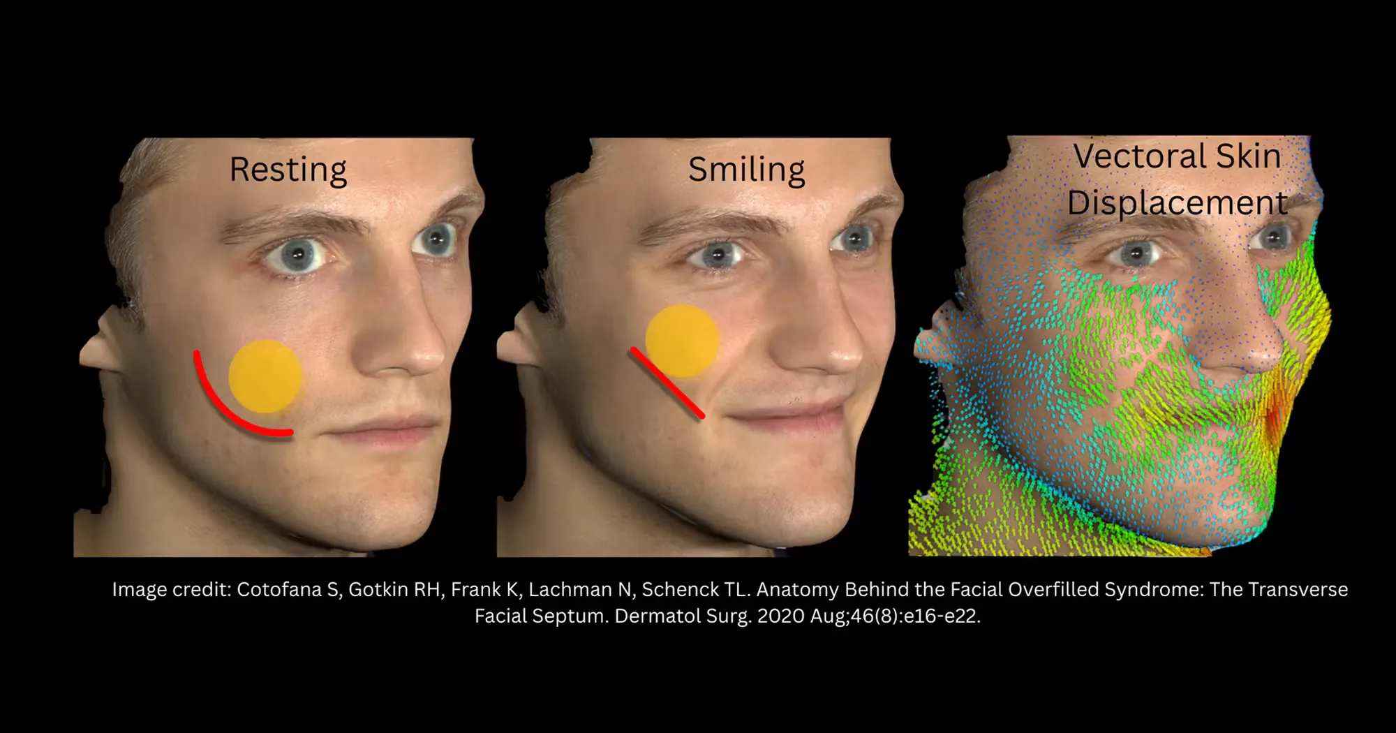 Photographic presentation of volume decrease in the facial joker line