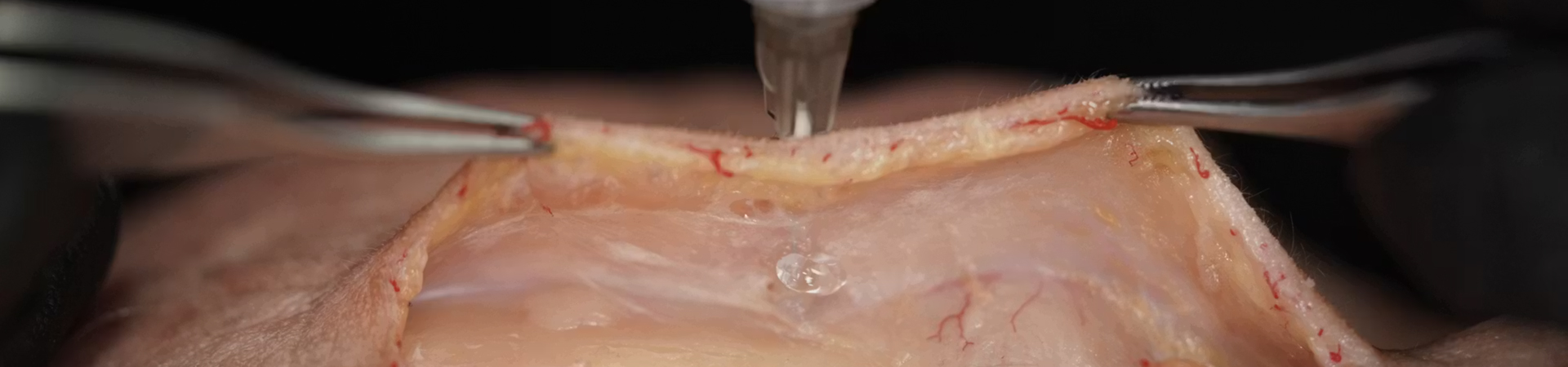 Treating Frontal Hollowing: Deep Needle Technique