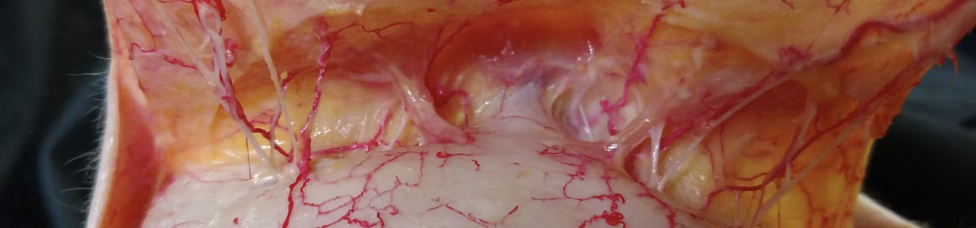 Understanding and Avoiding Toxin-related Adverse Events: Glabella